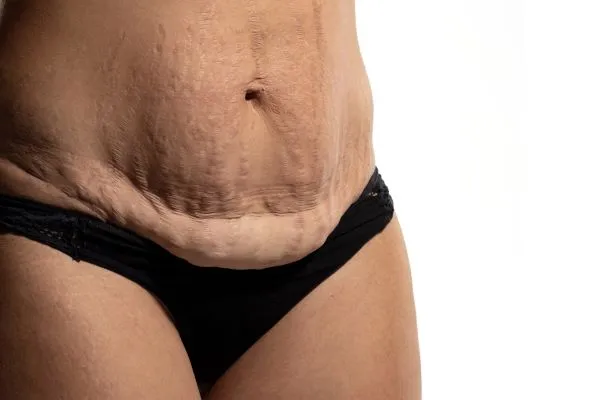 The Science of Skin Tightening 1 The science behind skin tightening East Malling picture of a woman's sagging skin on the stomach